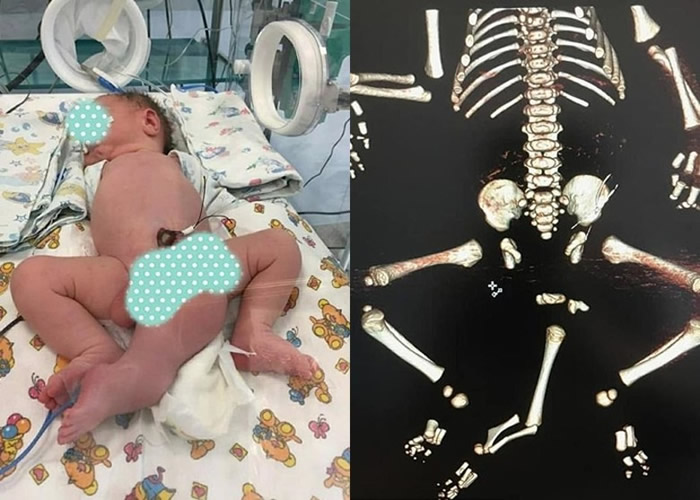 俄罗斯男婴出生拥有3条腿、两个生殖器和没有肛门 顽强历多次手术后获新生