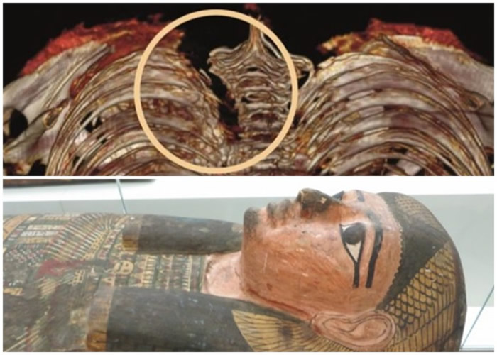 英国北爱尔兰贝尔法斯特阿尔斯特博物馆古埃及木乃伊扫描显示贵族妇人或被刀刺杀死亡
