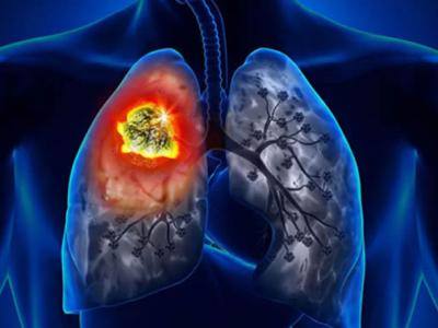 俄罗斯莫斯科国立罗蒙诺索夫大学科学家发现维生素B1可以抑制肺癌细胞