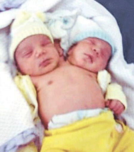 双头婴儿事件图片,巴西双头婴儿共用心脏