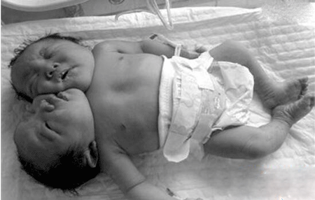 双头婴儿事件图片,巴西双头婴儿共用心脏