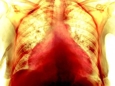 COVID-19如何伤害我们的心脏？科学家早就怀疑其不只是肺脏疾病 也是心血管疾病