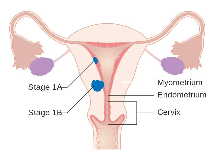 英国癌症研究中心资助的研究显示：女性终身超重会使其患子宫内膜癌的风险翻倍