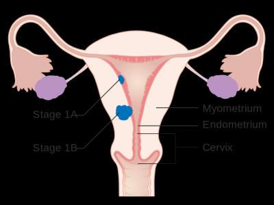 英国癌症研究中心资助的研究显示：女性终身超重会使其患子宫内膜癌的风险翻倍